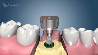 Dental Implant Procedure  Two Stage 🦷 Award Winning Patient Education [upl. by Meletius]