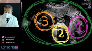 Gestação Trigemelar 30 Semanas  ultrassom Experiência Única e Desafiadora [upl. by Nappy]