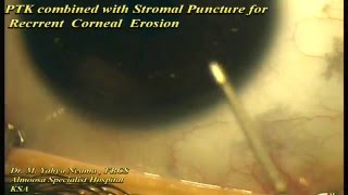 PTK with stromal Puncture for RCE [upl. by Kessiah]