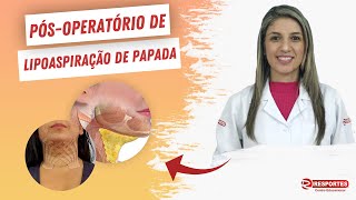 TAPING NA ESTÉTICA PósOperatório de LIPOASPIRAÇÃO DE PAPADA [upl. by Ajaj]