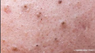 So satisfying blackheads whiteheads and pimples removal 2 pimpleremedies blackheadsolutions [upl. by Dib]