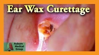 Ear Wax Removal of a Full Ear  Auburn Medical Group [upl. by Sawtelle]