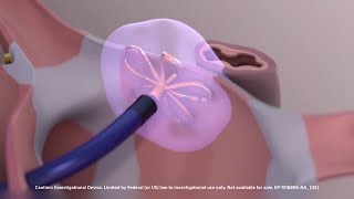 FARAPULSE™ Pulsed Field Ablation System Animation [upl. by Darce258]