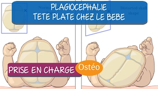 Problème de crâne plat chez le bébé des solutions [upl. by Acirema]