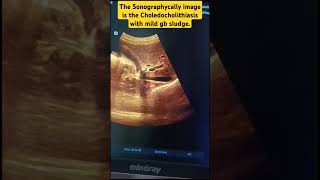 The Sonographycally image is the Choledocholithiasis with mild GB Sludge [upl. by Arrol]