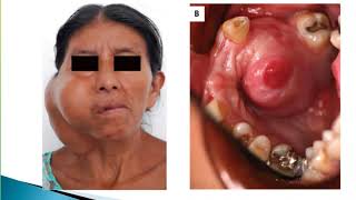 Malignant Pleomorphic Adenoma [upl. by Dhruv924]