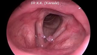 Video Laryngoscopy  How Vocal Polyp Look Like [upl. by Philbert625]