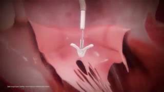 New treatment for severe mitral regurgitation by cardiologist Lee MacDonald MD MitraClip [upl. by Aztirak482]