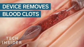 How This Device Safely Removes Blood Clots  Tech Insider [upl. by Dorreg974]