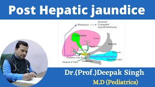 Post Hepatic jaundice  Obstructive jaundice  Deepak PD Singh [upl. by Dallas]