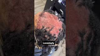 Sensitive Scalp Transformation 😱 [upl. by Nosduj]