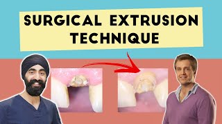 Surgical Extrusion Technique Saving Hopeless Teeth  PDP061 [upl. by Leahcimrej803]