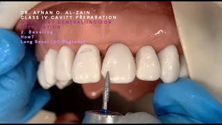 Class IV preparation and beveling – Maxillary central incisor 21  Arabic عربي [upl. by Harman]