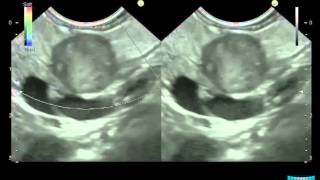 EUS in Solid Pancreatic Lesions Detection Characterization amp Assessment of Resectability [upl. by Fisher]