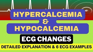 Hypercalcemia and Hypocalcemia ECG changes with 6 Examples Mechanism and Detailed Explanation [upl. by Llennol]