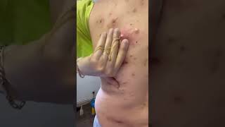 Cystic Acne Removal amp Inflammatory Acne [upl. by Eniksre70]