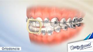 Corrección de mordida y espacios dentales quotOrtodonciaquot [upl. by Arhaz333]