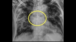 TMT XRAY CHEST  45F with high grade fever [upl. by Aitam]