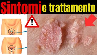 Attenzione HPV sintomi nascosti che devi conoscere e come trattare [upl. by Outlaw645]