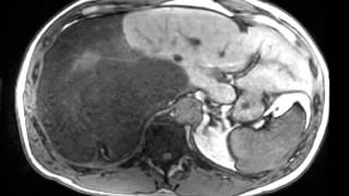 Dedifferentiated Retroperitoneal Liposarcoma [upl. by Ydac]