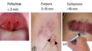 Bleeding diathesis Hemorrhagic Diathesis made simply [upl. by Yniattirb172]