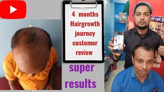 crown area hair regrowth  hard  receding hairline regrowth 90 cover whithin 4month no transplant [upl. by Nolahc]