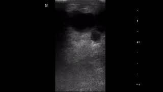 CASE 1088 BREAST FCC fibrocystic changes [upl. by Juliet785]