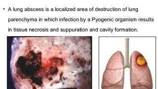 sana 3suppurative lung diseases [upl. by Agee]