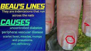 Beaus Line nail  Beaus Line Fingernails Depression in nails [upl. by Inaffit697]