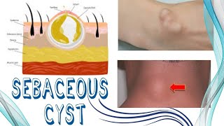 Sebaceous Cyst  Causes Diagnosis and Treatment  Surgical Procedure [upl. by Bobine]