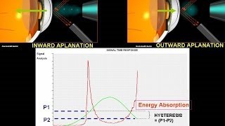 How does ocular response analyser works [upl. by Annyl]