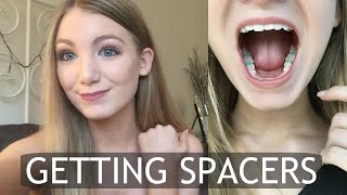 Getting Spacers for Braces  My Experience [upl. by Eivad]