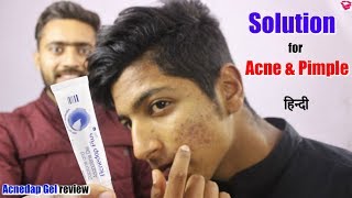 Best gel for Acne and Pimples  Effect Results How to use  Acnedap plus gel review [upl. by Pernick316]