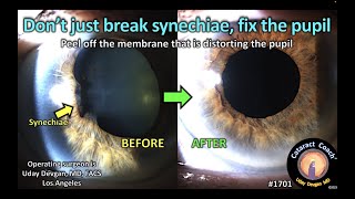 CataractCoach™1701 dont just break synechiae fix the pupil [upl. by Annavaig]