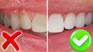 Dentist Reveals How to Whiten Teeth ULTRA WHITE amp FAST How They Stain amp Why You Bleach Longer [upl. by Tumer164]