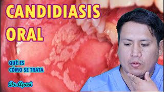 COMO ELIMINAR LA CANDIDIASIS EN LA BOCA [upl. by Aihseken]