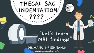 What is Thecal Sac indentation  Learn to read MRI [upl. by Oijres258]