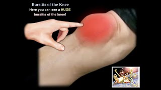 Knee Bursitis  Everything You Need To Know  Dr Nabil Ebraheim [upl. by Ainessey49]