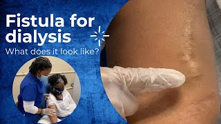 What does a fistula for dialysis look like CHT CERTIFICATION REVIEW 2022 [upl. by Lakym]