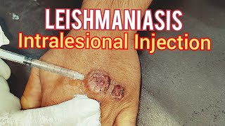 Leishmaniasis Treatment [upl. by Gottwald]