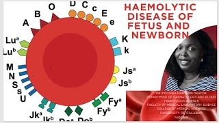 HAEMOLYTIC DISEASE OF THE FETUS AND NEWBORN hdfn hdn titration [upl. by Goodspeed]