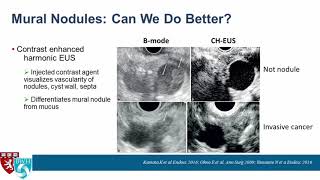 EUS of Pancreatic Cysts What’s New [upl. by Orlan333]