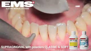 Air Flow Teeth Polishing Solihull [upl. by Iron]