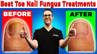 Best Toe Nail Fungus Treatments Onychomycosis Remedies [upl. by Nevets]