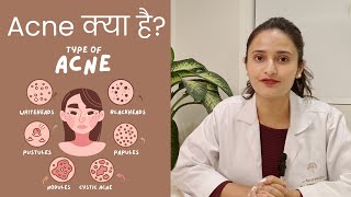 What is Acne  Types Of Acne  Acne Treatment [upl. by Esertap298]