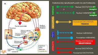 Challenges with Parkinsons disease [upl. by Lowell816]