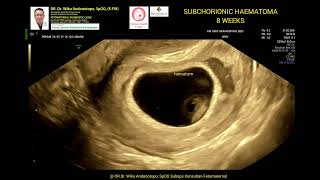 Subchorinic Haematoma 8 weeks [upl. by Nerraf]