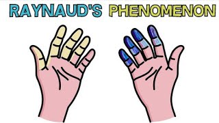 RAYNAUDS SYNDROME  CAUSE APPEARANCE DIAGNOSIS AND TREATMENT  RAYNAUDS PHENOMENON [upl. by Murial]