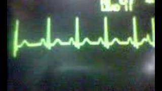 ECG Video Ectopics  Atrial [upl. by Lelah276]