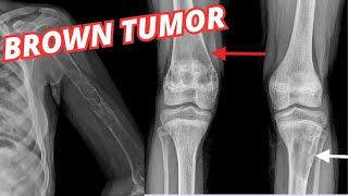 What is BROWN TUMOR  Brown Tumor And Hyperparathyroidism [upl. by Ahcirt]